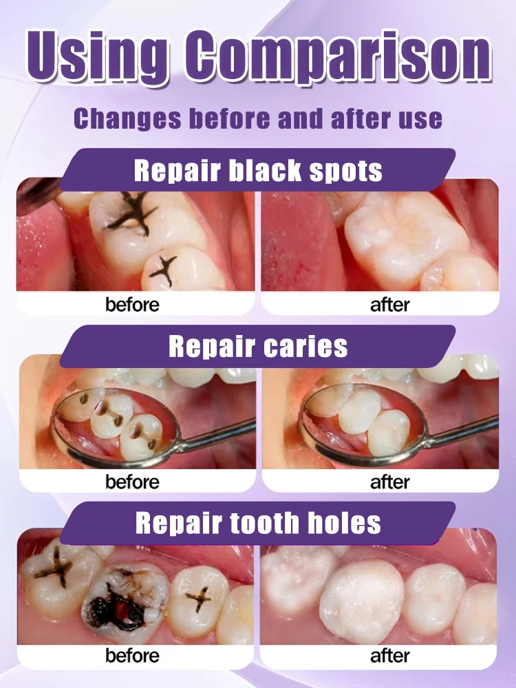 Tooth Decay Repair Gel Paste