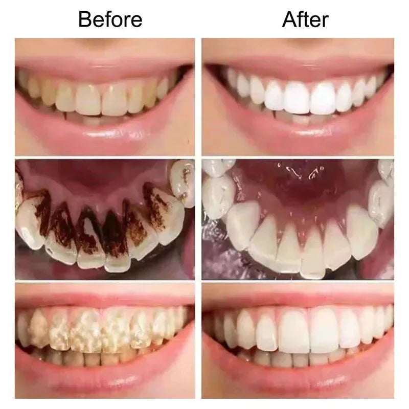 Cleaning Dental Bleaching Tools