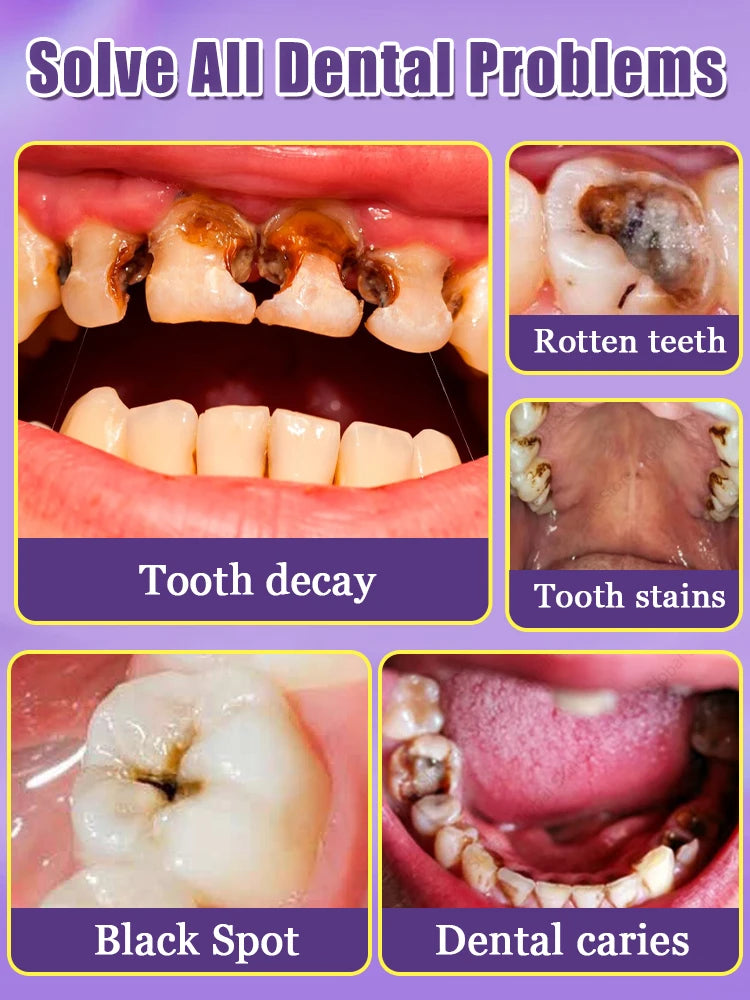 Tooth Decay Repair Gel Paste