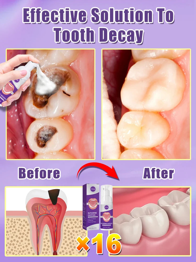 Tooth Decay Repair Gel Paste