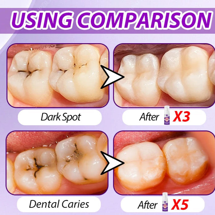 Tooth Decay Repair Solution Paste